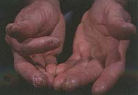 [Bild, Sjukdomssymptom]